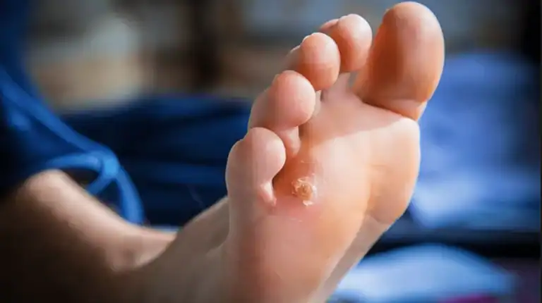 blisters