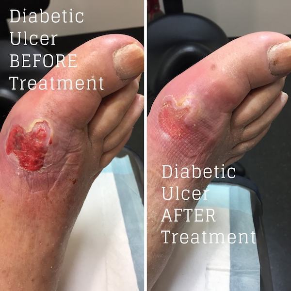 Ways to care for your diabetic feet
