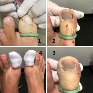 Ingrown Toenail Removal: How To Properly Cut Out Ingrown Nails | Footfiles