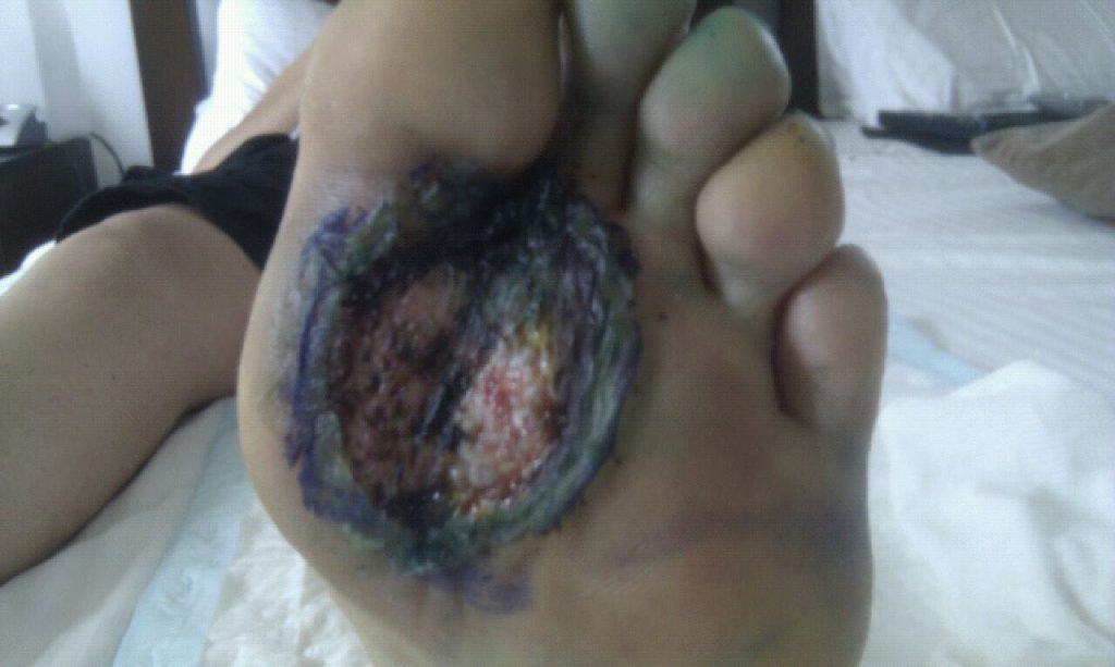 skin cancer on sole of foot