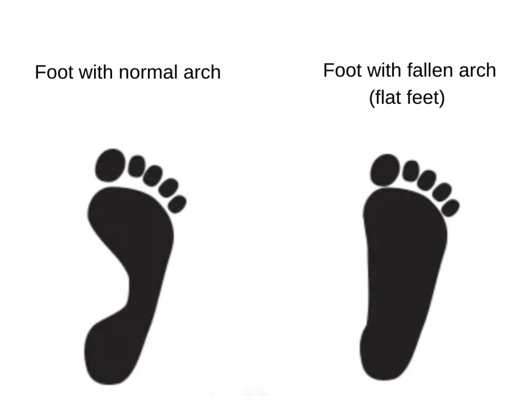 Flat Feet causes and treatment
