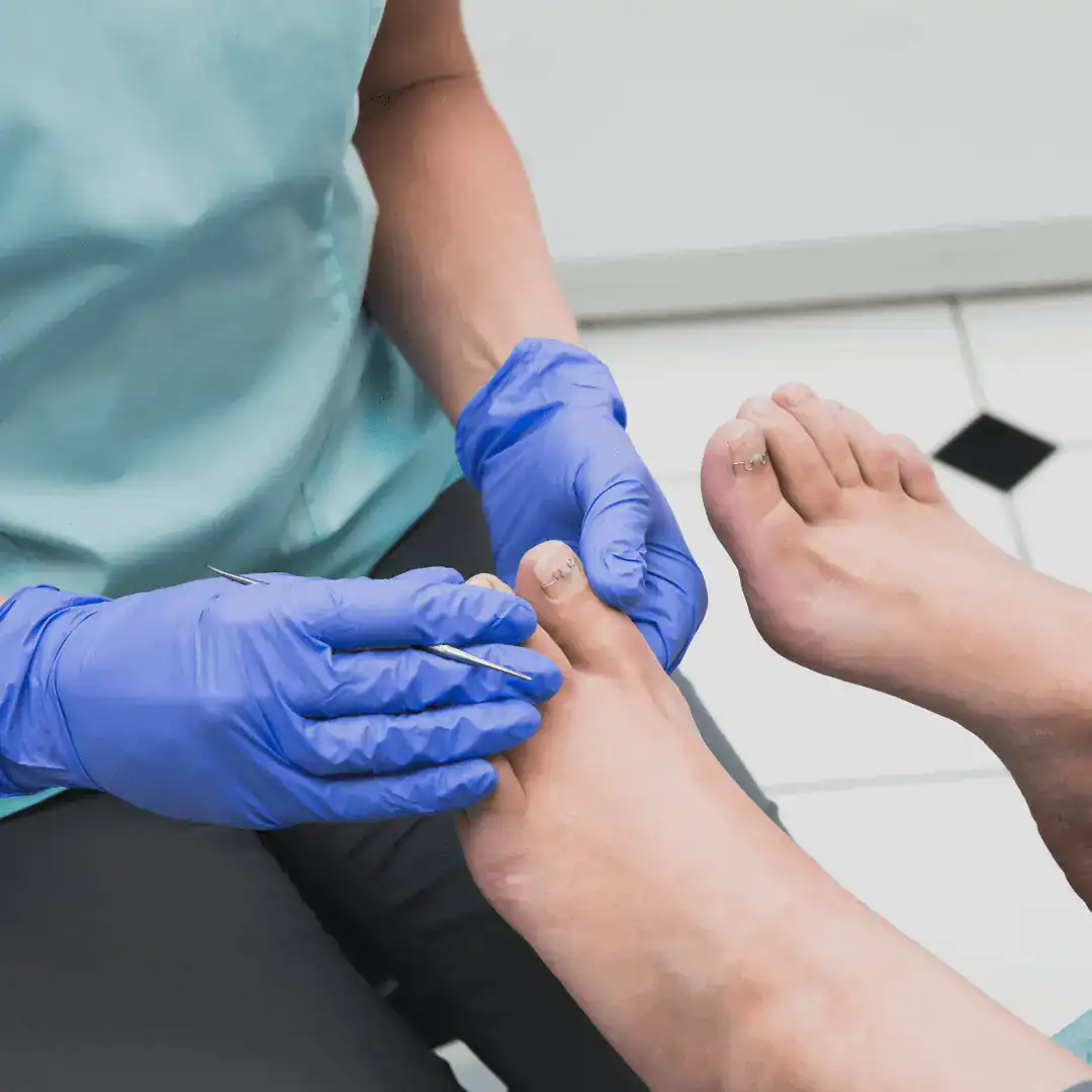 Ingrown Toenail Surgery