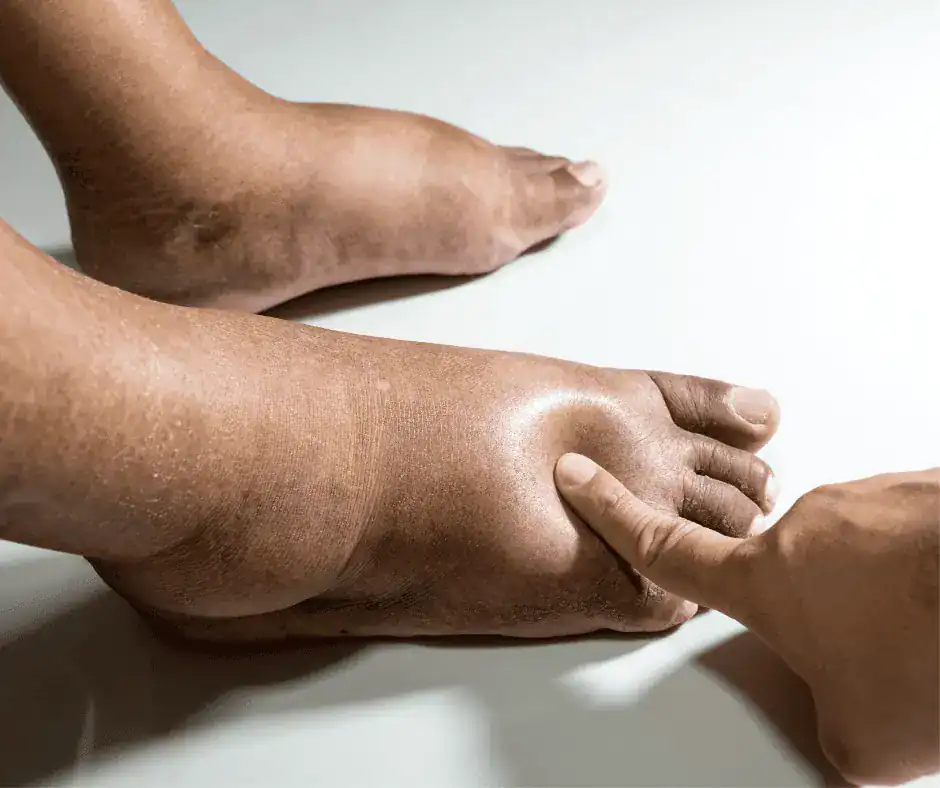 diabetes foot