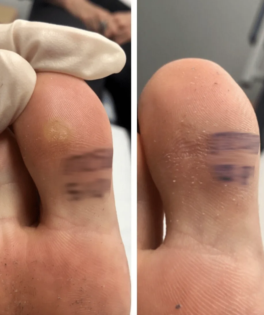 wart removal with swift microwave therapy