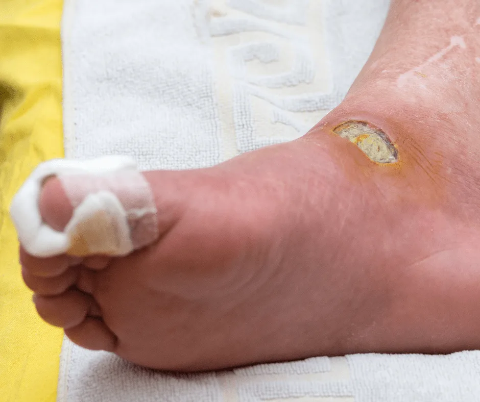 go to a podiatrist or doctor to look after a diabetic foot ulcer